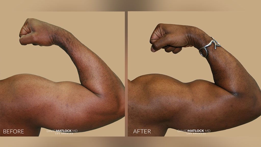 Advanced Surgical Bodybuilding Gallery - Visthetic Med Spa